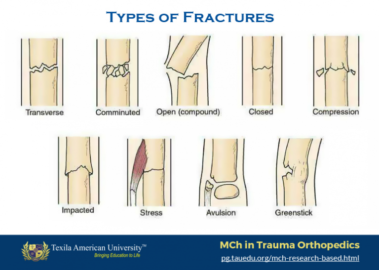 Types-of-Fractures